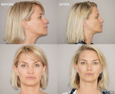 What is nasal tip surgery? Rhinoplasty Ocean Clinic Marbella