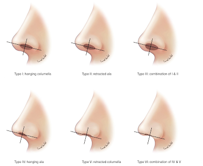 Who can benefit from nasal tip surgery? Rhinoplasty Ocean Clinic Marbella