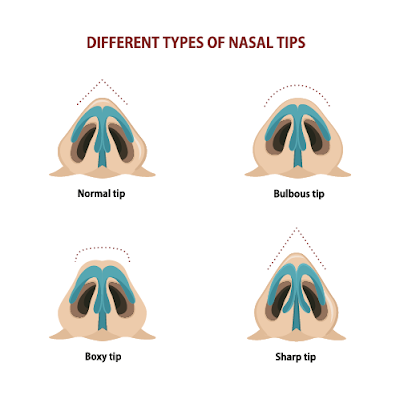 Nasal tip surgery for a bulbous, wide or narrow nose. Rhinoplasty Ocean Clinic Marbella
