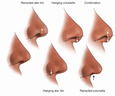 Nasal tip surgery for reshaping of nostrils. Rhinoplasty Ocean Clinic Marbella