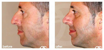 Rhinoplasty - If your nose is too big