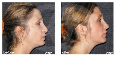 Rhinoplasty - If your nose is too long