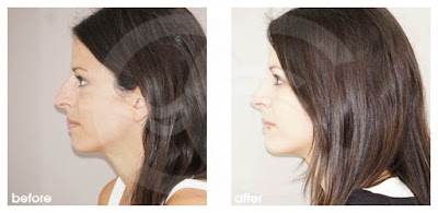 Rhinoplasty - If your nose is bumpy or wonky