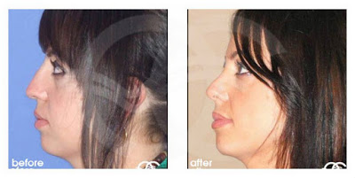 Rhinoplasty - learn about your options