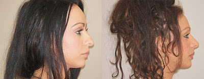 Rhinoplasty before and after patient Ocean Clinic