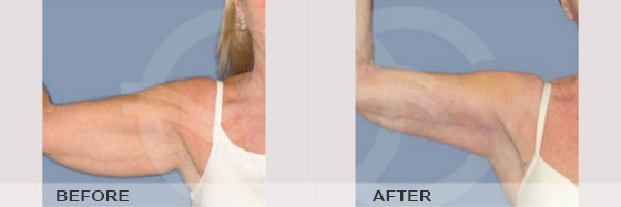 Upper Arms Brachioplasty - Before & After | Marbella Ocean Clinic