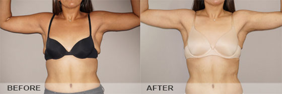 Bilateral Brachioplasty with Skin Excision and Liposuction - Before & After | Marbella Ocean Clinic