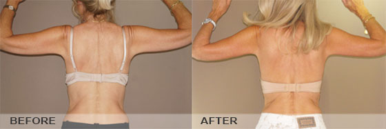 Upper Arm Lift with Liposuction - Before & After | Marbella Ocean Clinic