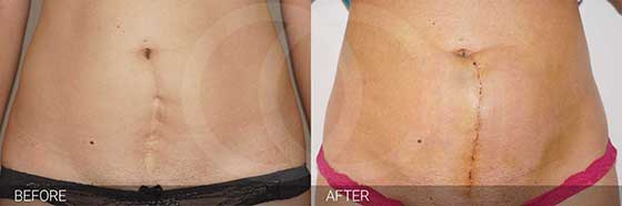 Scar correction - Everything You Need to Know Marbella Madrid Ocean Clinic