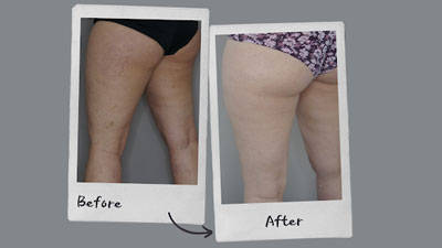 Stretch Mark Treatment - a new innovation in aesthetic medicine