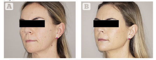 (A) Panfacial before, and (B) after. Microfat chin 7 cc total, mandibular 8 cc, gonial angle 6 cc, upper/lower lips 2 cc each, philtrum/supraoral 6 cc, malar 6 cc ,infraorbital 2 cc, lat brow 2 cc, temples 6 cc per side. Marbella Ocean Clinic