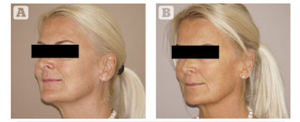 (A) Periorbital before, and (B) after. Microfat, 4 cc infraorbital, 3 cc lateral brow. Marbella Ocean Clinic