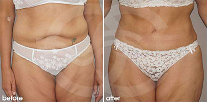 Abdominoplasty - Tummy Tightening | Ocean Clinic Marbella