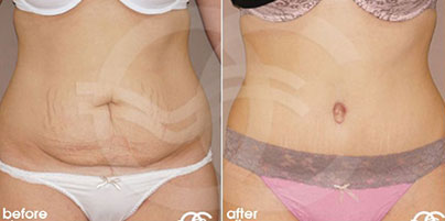 Liposuction - Tummy Tightening | Ocean Clinic Marbella