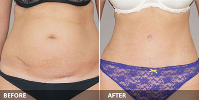 Mommy Makeover - Tummy Tightening | Ocean Clinic Marbella