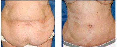 Tummy Tuck - Your weight. Marbella Ocean Clinic
