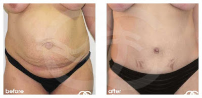 Tummy Tuck - Your health. Marbella Ocean Clinic