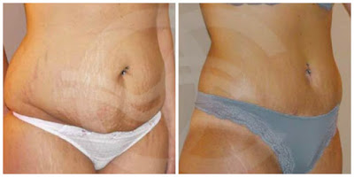 Tummy Tuck - Your body shape. Marbella Ocean Clinic