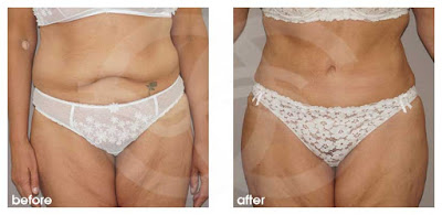 Tummy Tuck - Your age. Marbella Ocean Clinic