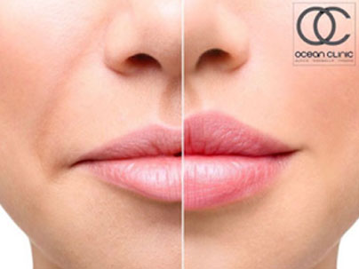 Lip Injections: The Tripod Technique and Skin Assessment | Ocean Clinic Marbella