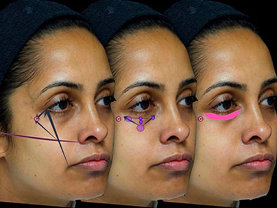 Tear Trough Fillers For Eye Bags Clinic Warwickshire