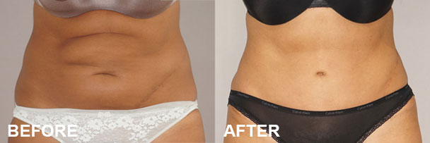 Procedimientos de contorno corporal Abdominoplastia Antes y después I | Ocean Clinic Marbella