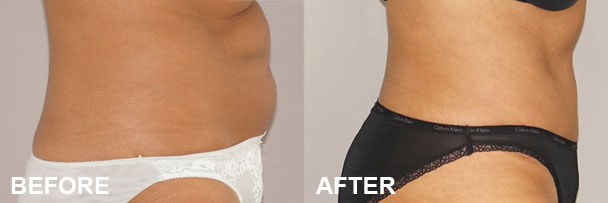 Procedimientos de contorno corporal Abdominoplastia Antes y después II | Ocean Clinic Marbella
