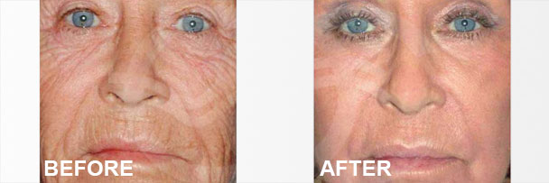 Tratamientos de rejuvenecimiento de la piel, Peelings químicos I | Ocean Clinic Marbella