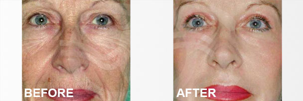 Tratamientos de rejuvenecimiento de la piel, Peelings químicos II | Ocean Clinic Marbella