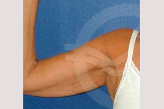 Arm Lift Liposuction Upper Arm ante/post-op I