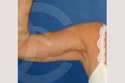 Arm Lift Liposuction Upper Arm ante/post-op I