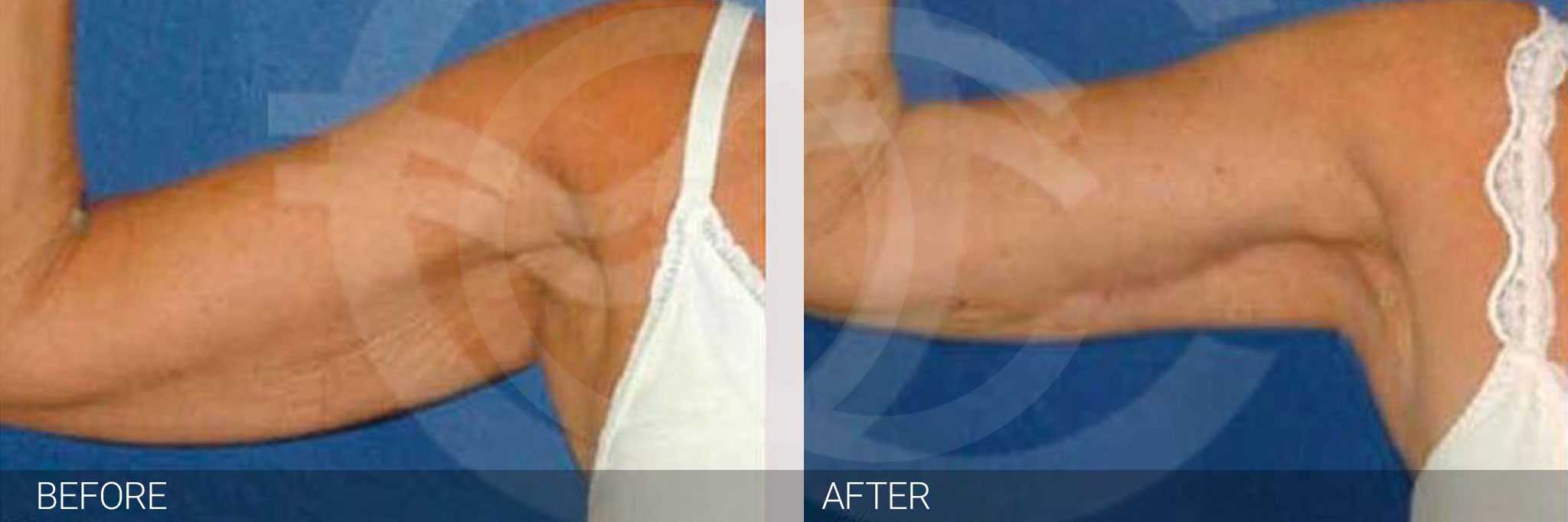 Arm Lift Liposuction Upper Arm ante/post-op I