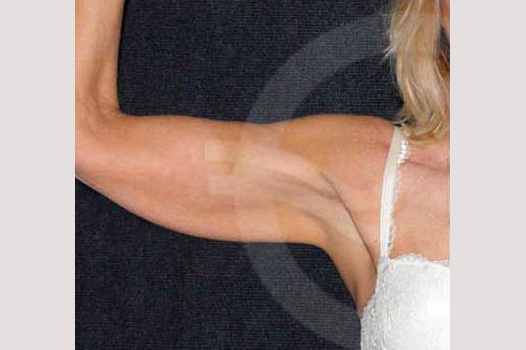 Arm Lift with Liposuction ante-op profil