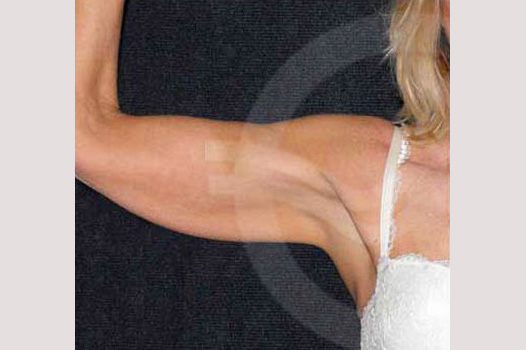 Arm Lift with Liposuction ante/post-op I