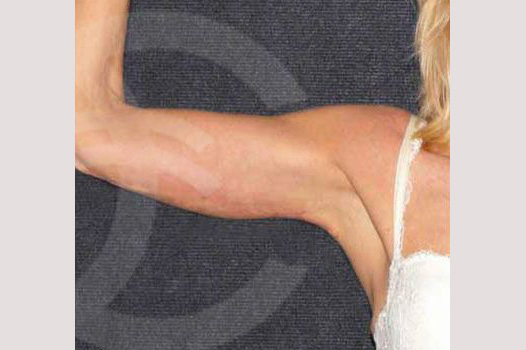 Arm Lift with Liposuction post-op profil