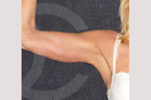 Arm Lift with Liposuction ante/post-op I