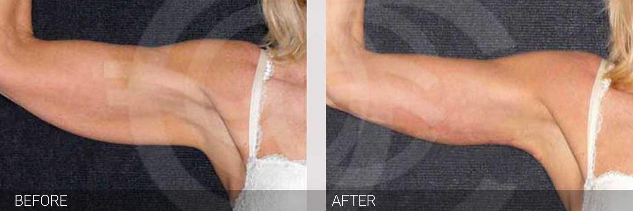 Arm Lift with Liposuction ante/post-op I