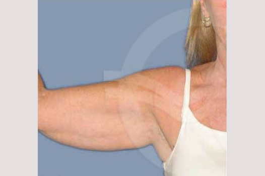 Arm Lift Upper arms ante/post-op I