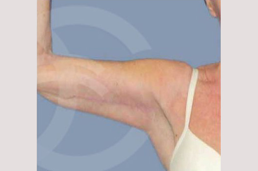 Arm Lift Upper arms ante/post-op I