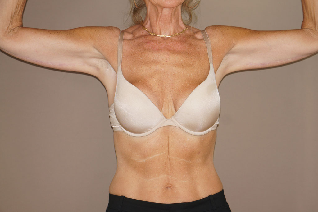 Arm Lift Upper Armlift ante/post-op I