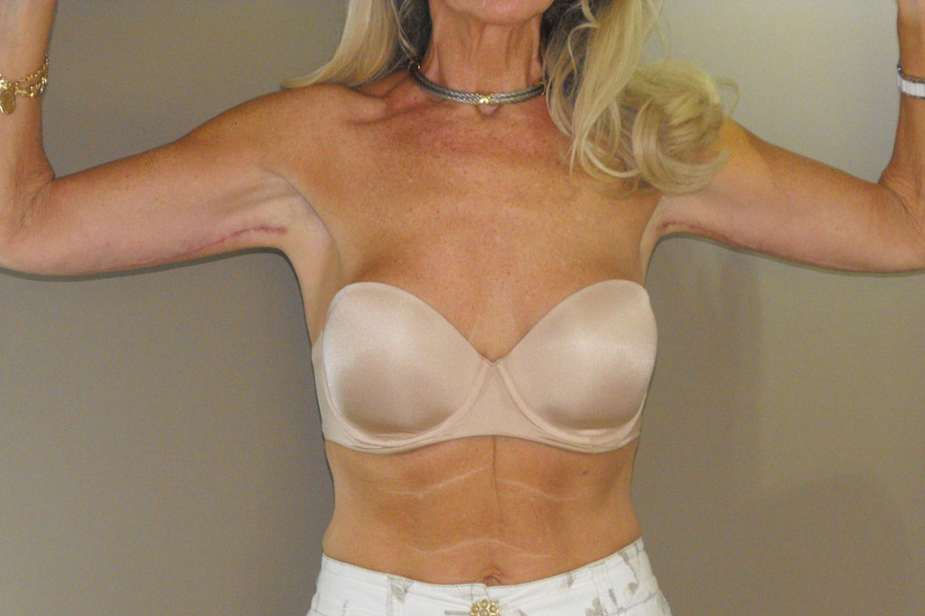 Lifting des bras 1 post-op profil