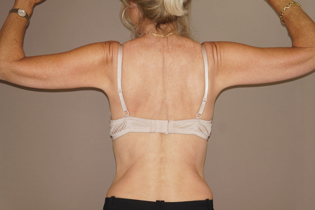Photos Arm Lift  ante/post-op II