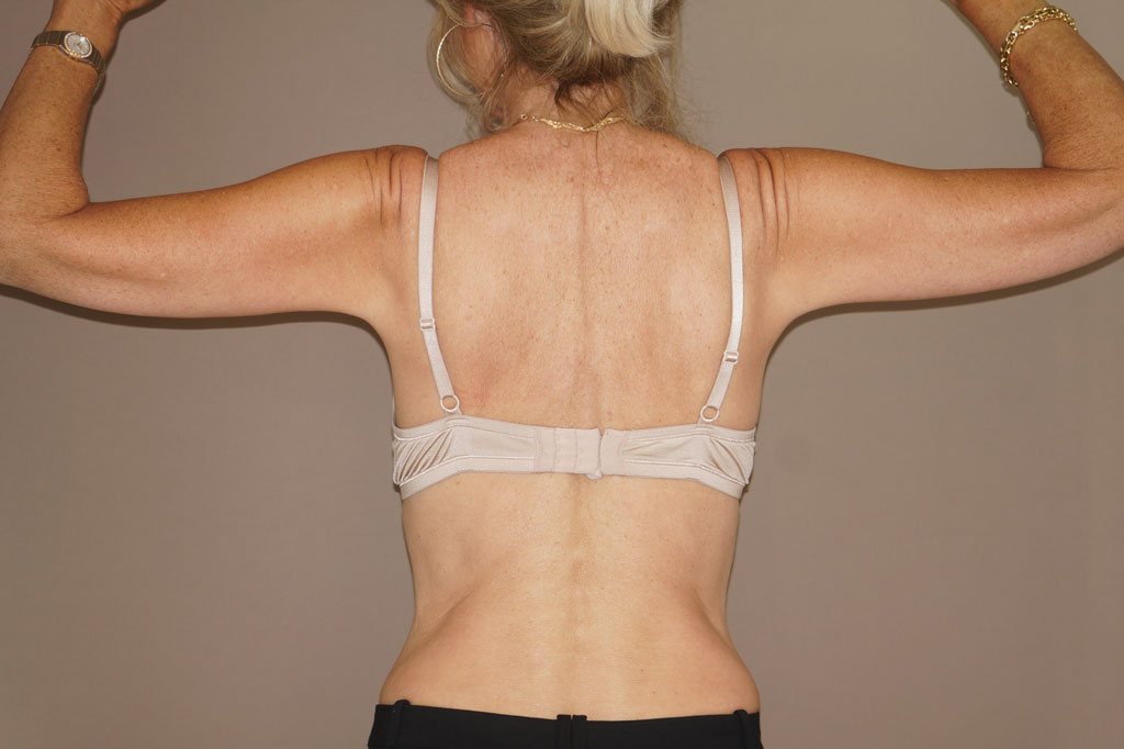 Arm Lift Upper Armlift ante/post-op II