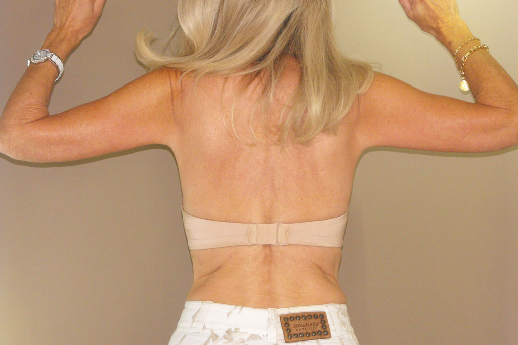 Photos Arm Lift  ante/post-op II