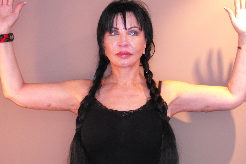 Fotos Lifting de brazos  ante/post-op I