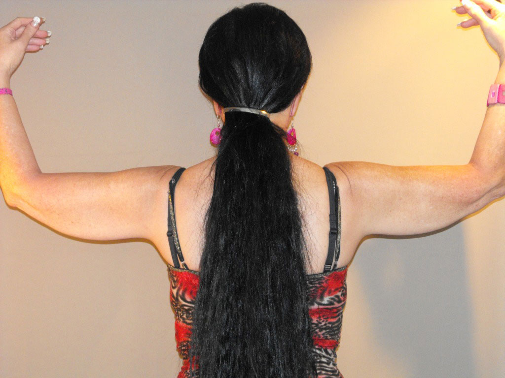 Fotos Lifting de brazos  ante/post-op II