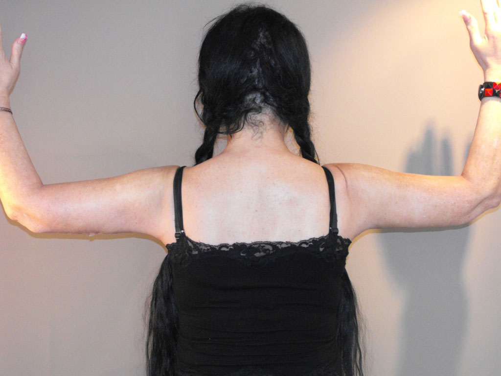 Arm Lift Reshape Upper Arms post-op lateral