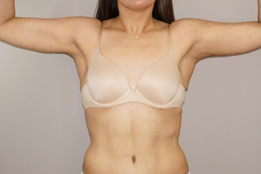 Lifting des bras 3 post-op profil