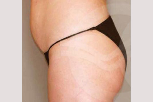 Buttock Augmentation BRAZILIAN BUTT LIFT ante/post-op I