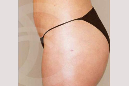 Gesäßvergrößerung BRAZILIAN BUTT LIFT ante/post-op I